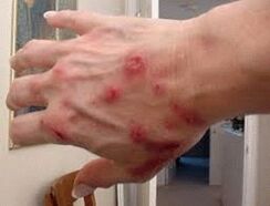 Pápulas na pel con helmintiasis